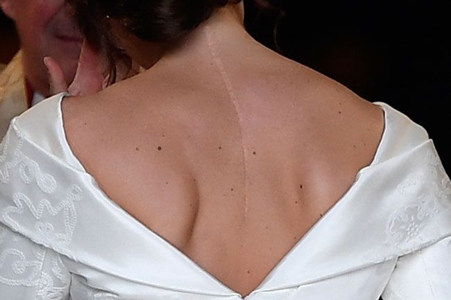 Princess Eugenies back scar wedding dress