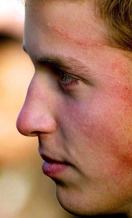 Prince William forehead scar