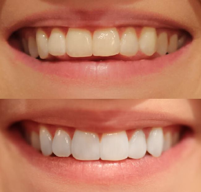 smile brilliant before and after reviews