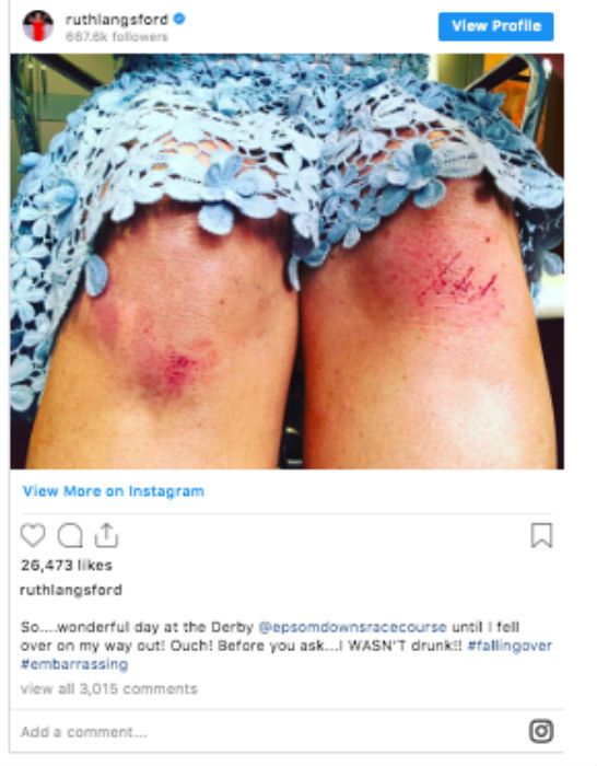 loose women ruth langsford injury