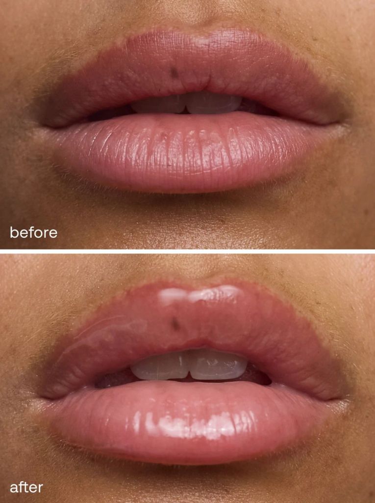 lip plump before after