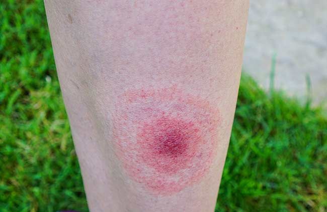 Lyme disease bite rash