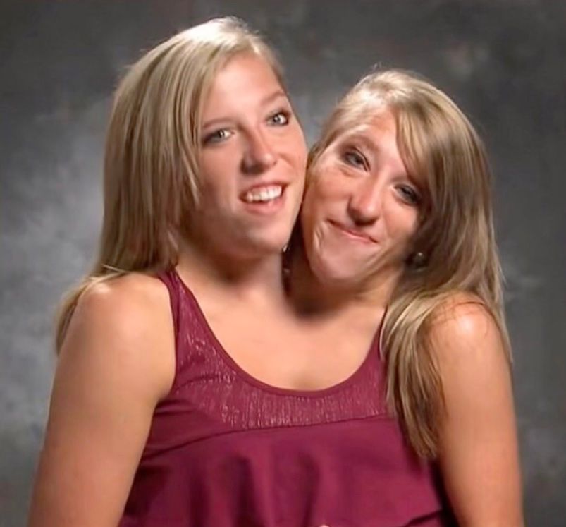 Abby and Brittany Hensel starred on the TLC reality TV show 