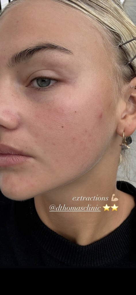 Mia shared her skincare treatments on Instagram