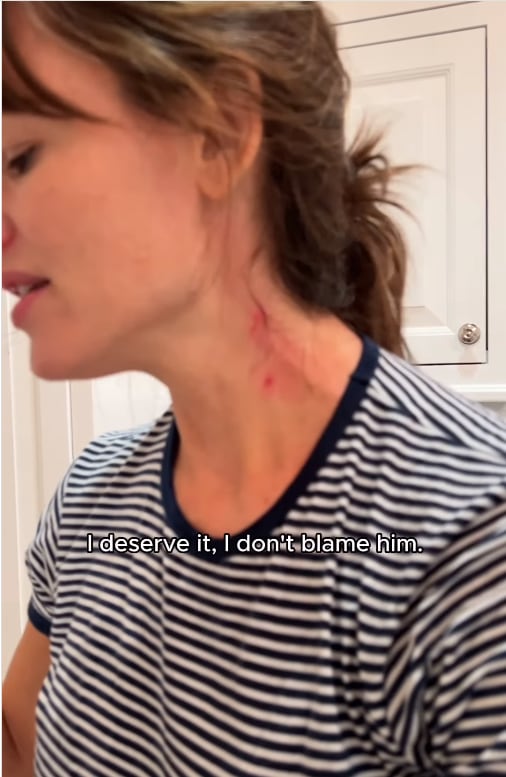 Jennifer shows her battle scars
