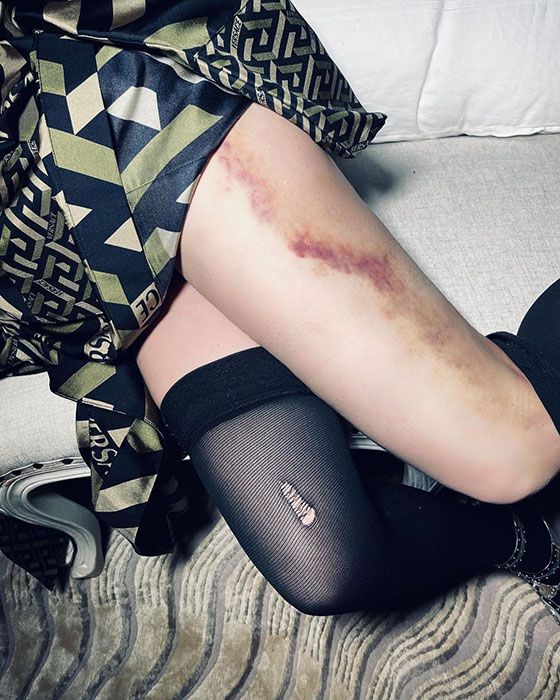 madonna leg bruise