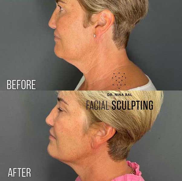 before after chin sculpting