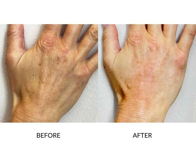 hand treatments before after