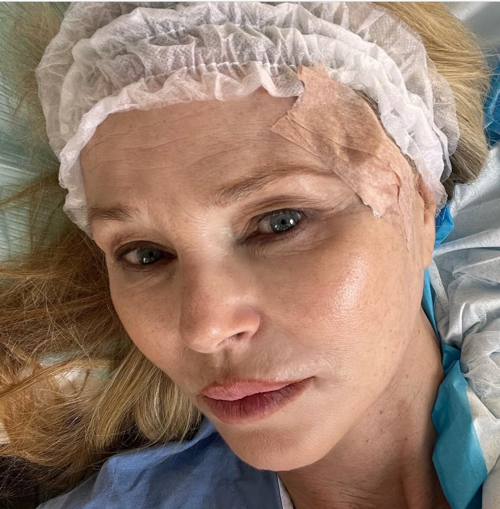Photo shared by Christie Brinkley on Instagram March 13, 2024, showcasing a scar on her temple as she revealed she had been diagnosed with basal cell carcinoma, the most common form of skin cancer