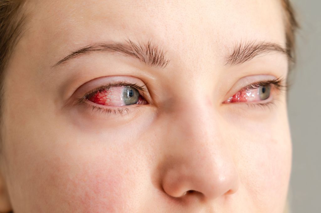 close up of woman with bloodshot eyes.