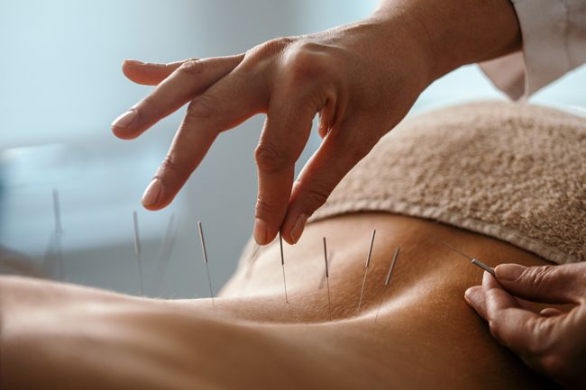 acupuncture being performed