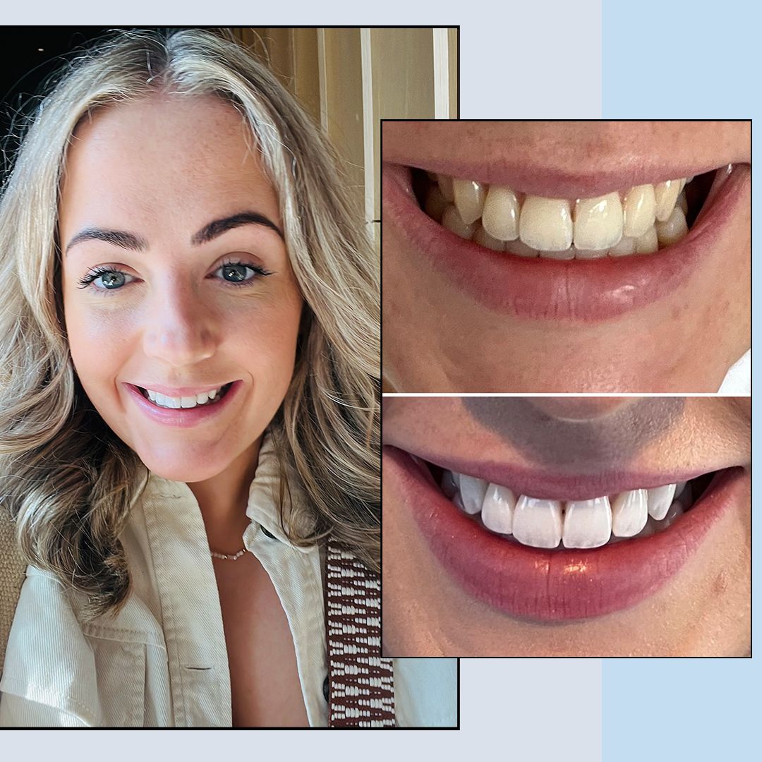Why my smile makeover changed more than just my teeth