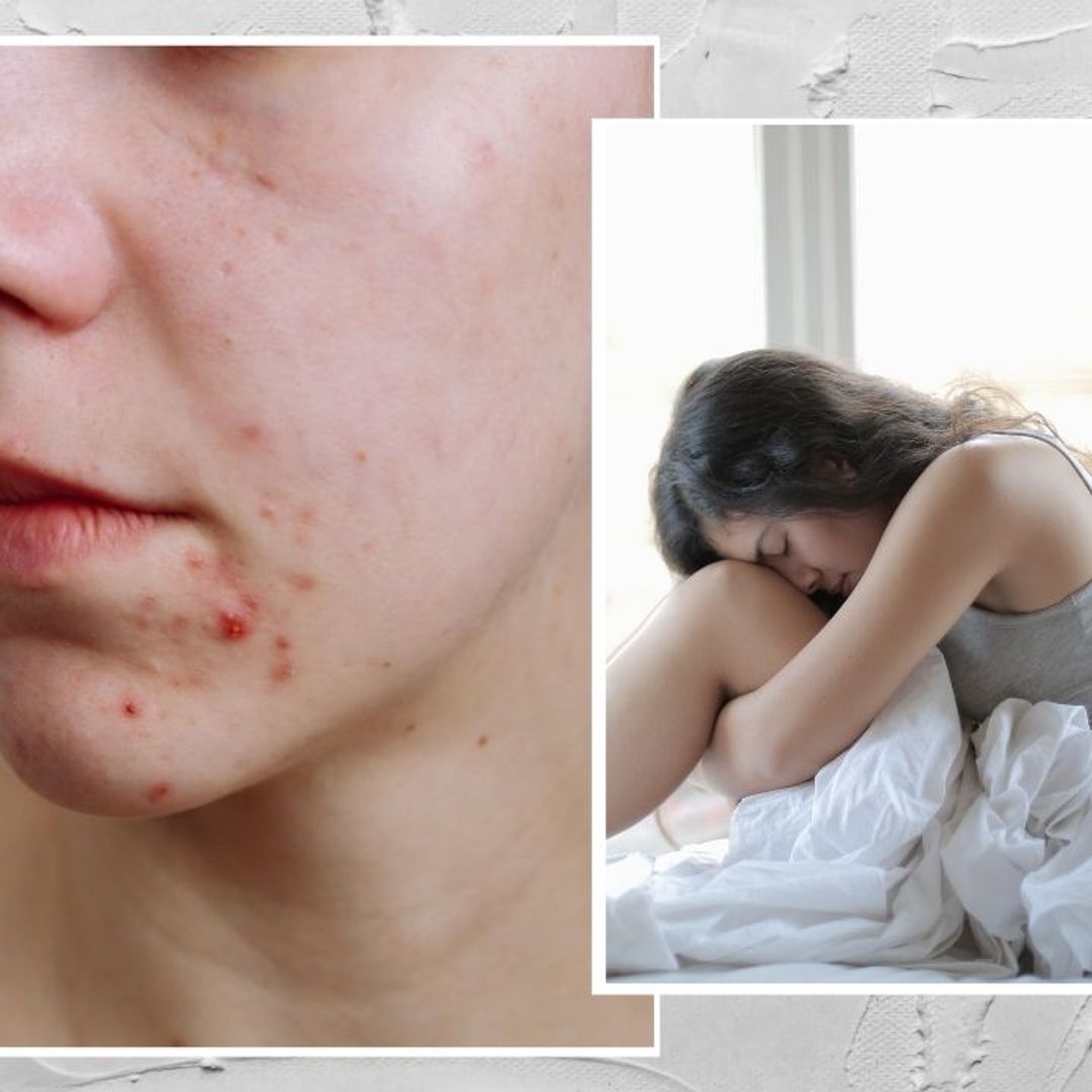 How stress affects the skin & acne: Post-lockdown skin problems