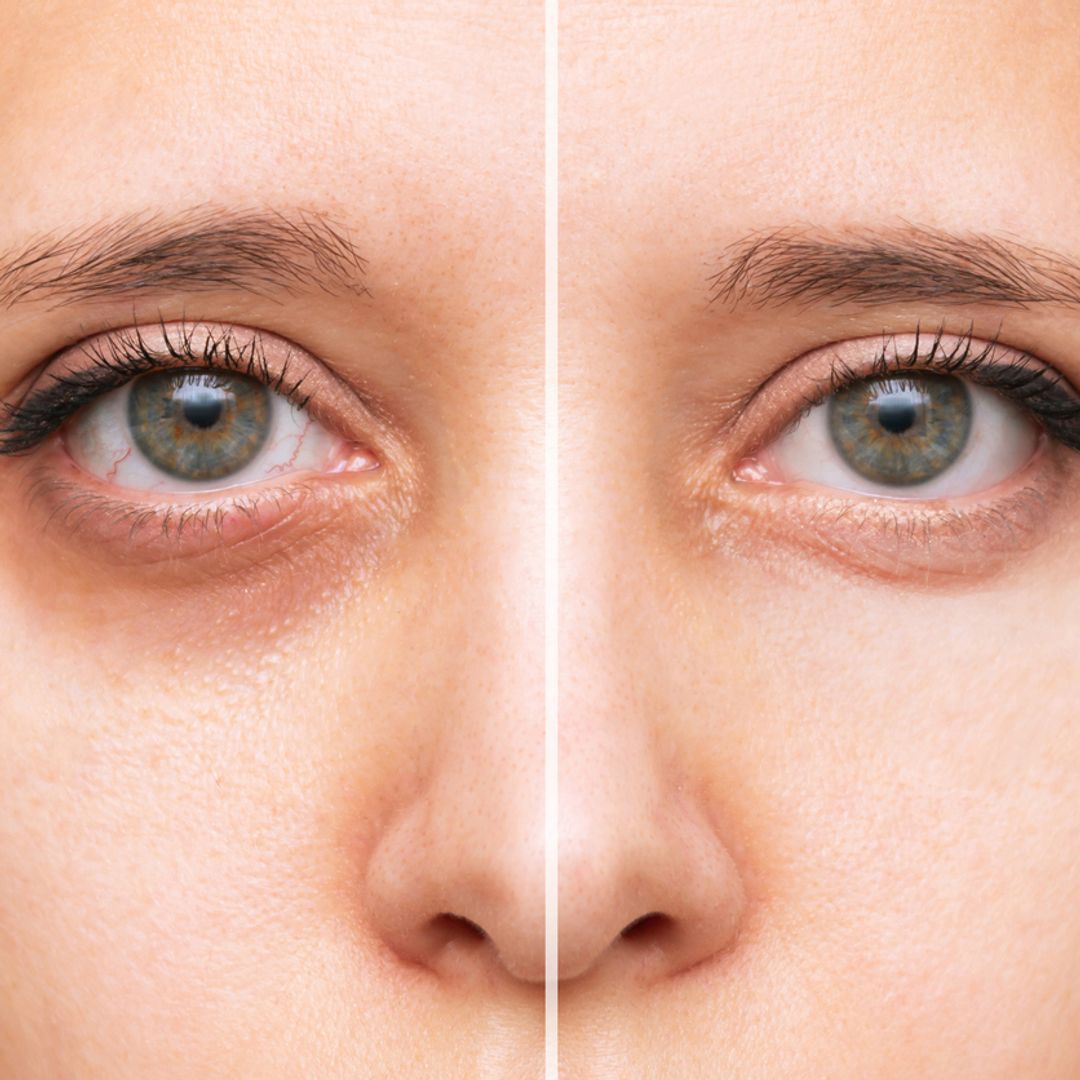 Why you really have dark circles: An expert explains the 4 types and how to fix them