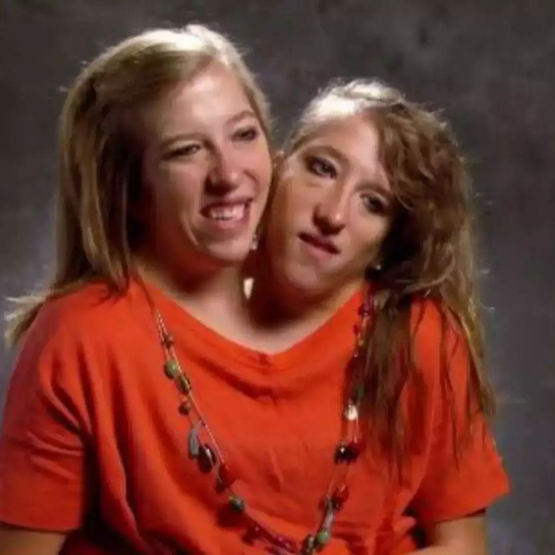 Conjoined twins Abby and Brittany Hensel reveal intimate details about their lives