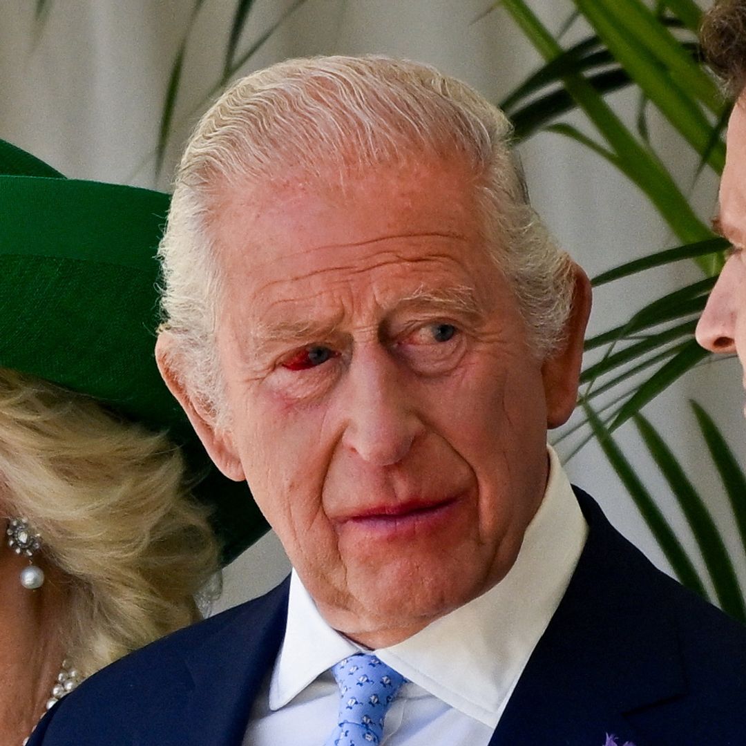 What happened to King Charles' eye?