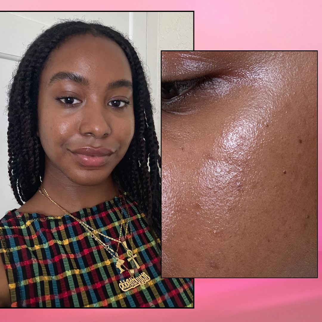 Everyone is getting their 'black girl freckles' removed - but I love mine