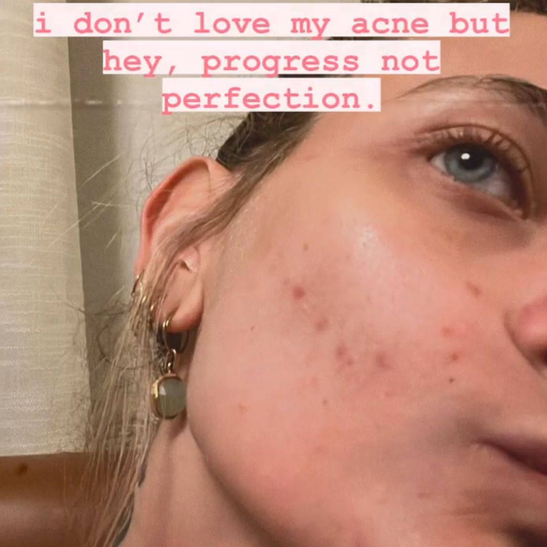 Paris in a selfie close up of her acne on her cheek