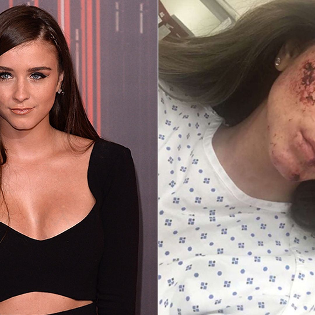 Corrie's Brooke Vincent shocks fans with bloodied face for new film role