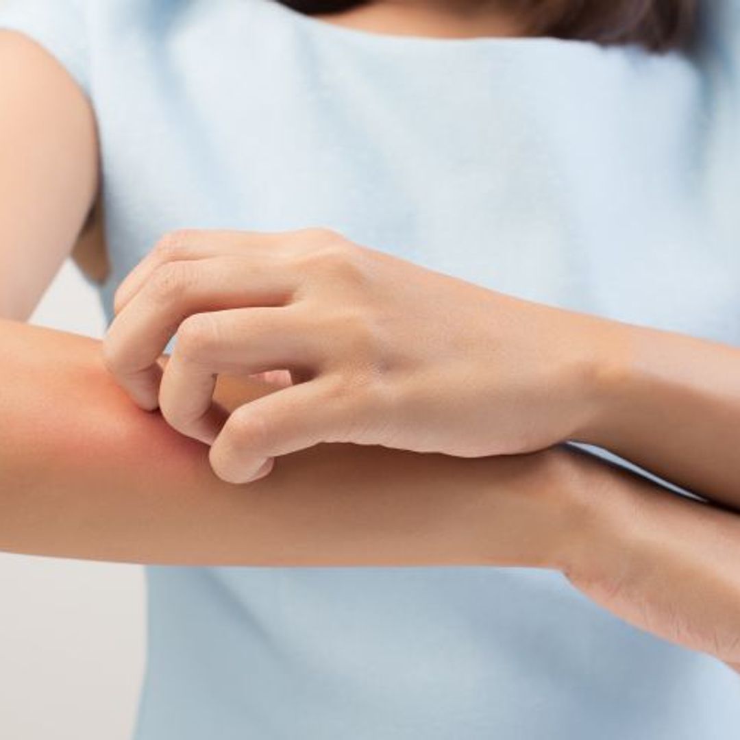 7 dermatologist tips for managing eczema