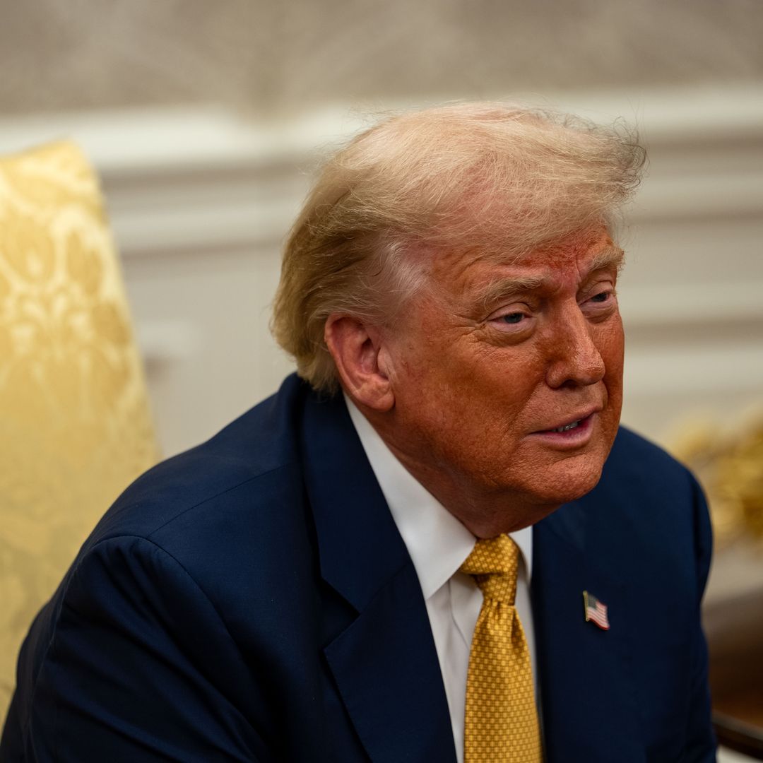 Donald Trump's health diagnosis confirmed as 'chronic' vein disorder following leg swelling, hand bruising