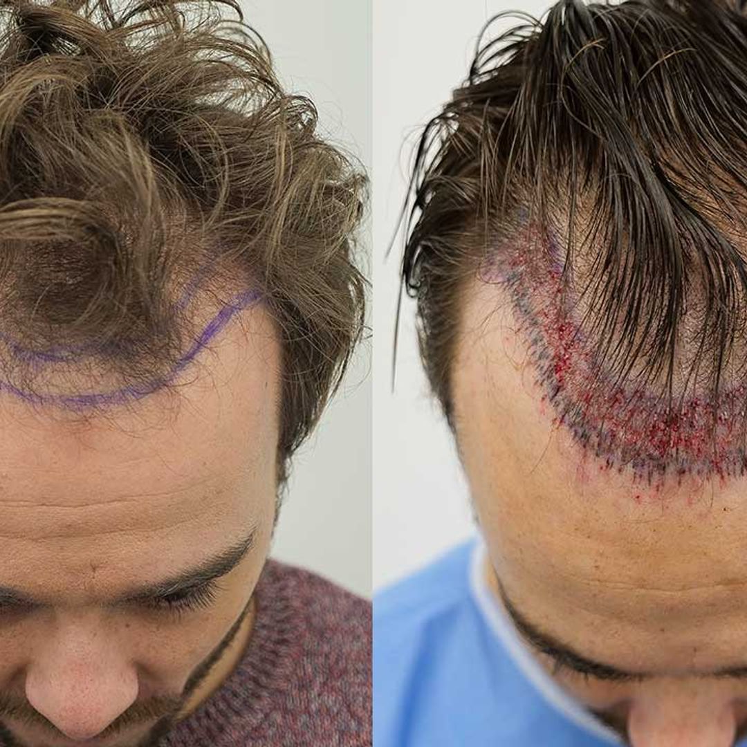 Coronation Street's Jack P. Shepherd receives hair transplant after hair falls out from stress – see the pictures