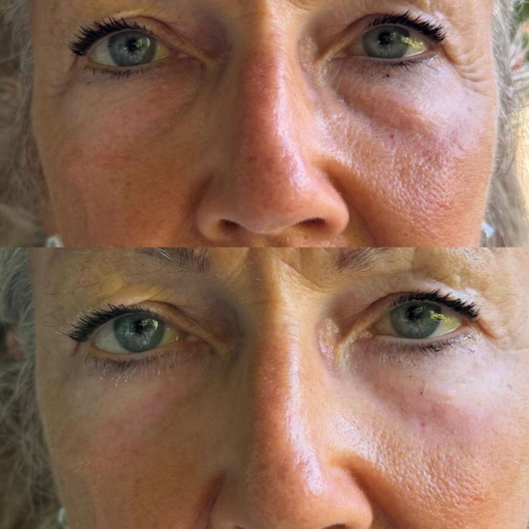 My mother-in-law was about to get eyelid surgery, then this new £15 eye gel changed everything