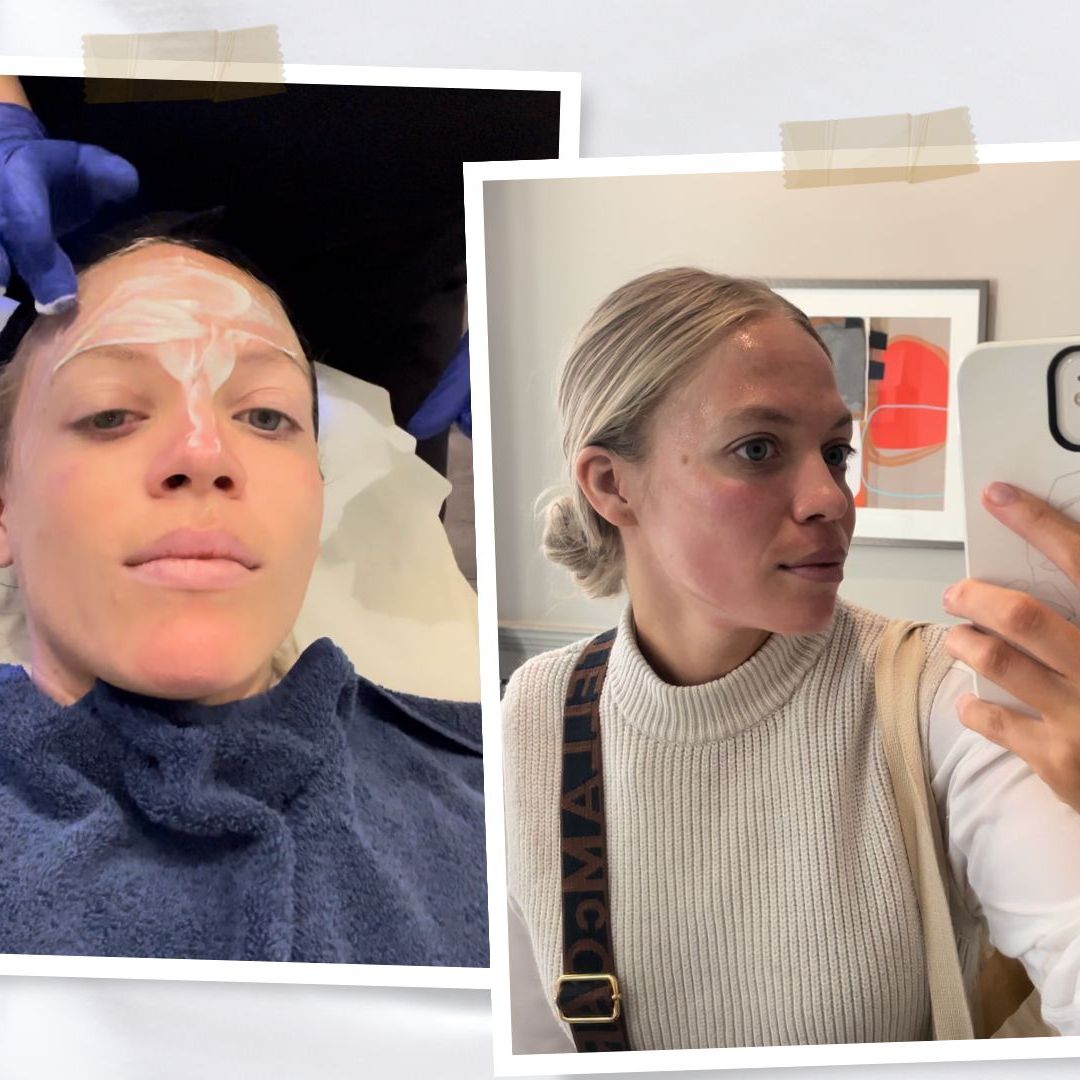 I tried microneedling for the first time and this is how it went