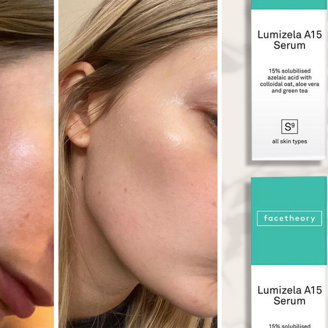 This best-selling azelaic acid is curing people’s breakouts