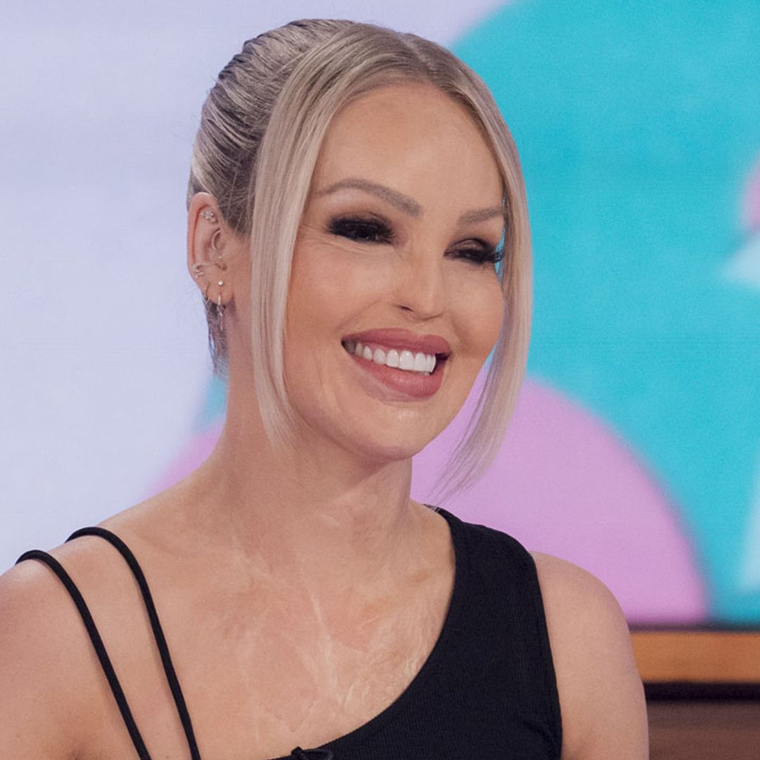 Katie Piper shares painful bruises caused by health issue: "People think you're clumsy"