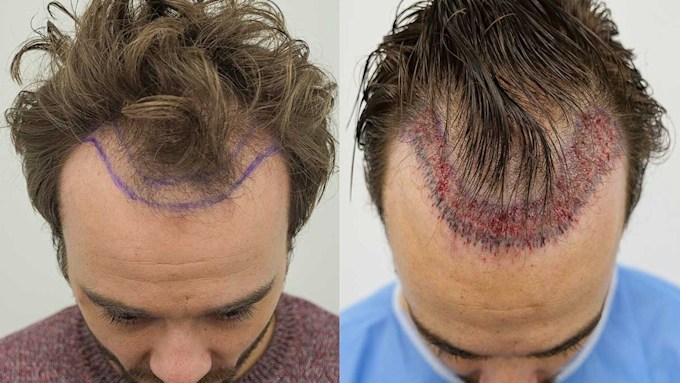 Coronation Street's Jack P. Shepherd receives hair transplant after hair falls out from stress – see the pictures | HELLO! Coronation Street's Jack P. Shepherd receives hair transplant after hair falls out from stress – see the pictures | HELLO!