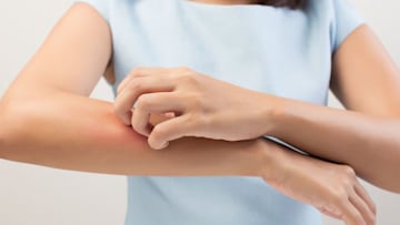 eczema-woman-scratching-arm
