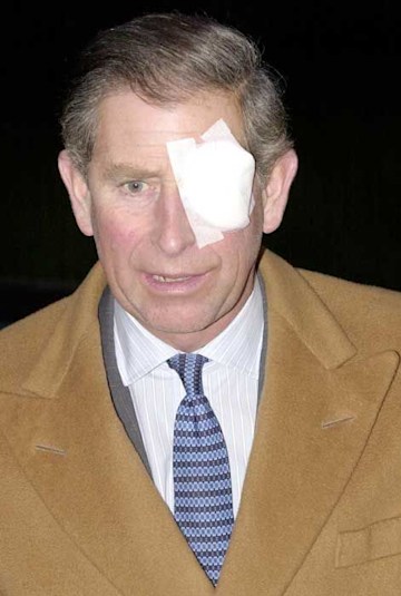 charles-eye-patch