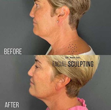 Jawline sculpting before and after: the best treatments for a defined jawline  HELLO!