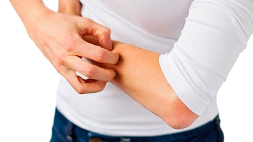 How to get rid of eczema naturally