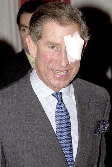 TrivDaily - 17 times the royals have sported injuries 61 prince-charles-eye-patch